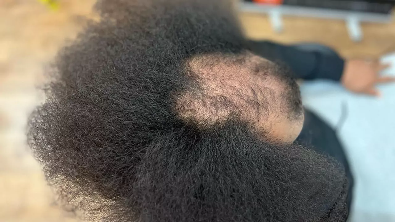 braid over bald patches category